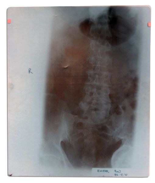 One-of-a-Kind Evel Knievel Spine and Pelvis X-Ray -- Taken After the Daredevil's Disastrous 1975 Wembley Stadium Jump