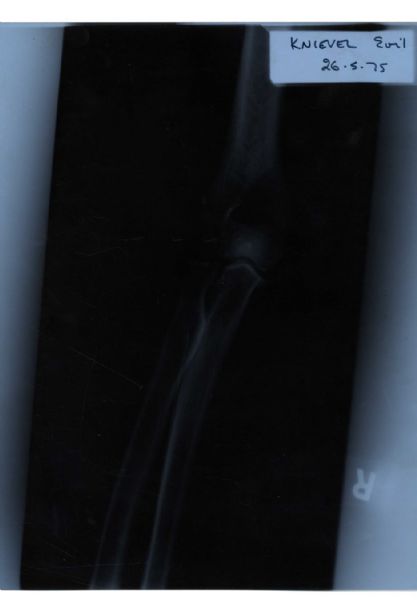 One-of-a-Kind Evel Knievel Right Elbow X-Ray -- Taken After the Daredevil's Disastrous 1975 Wembley Stadium Jump