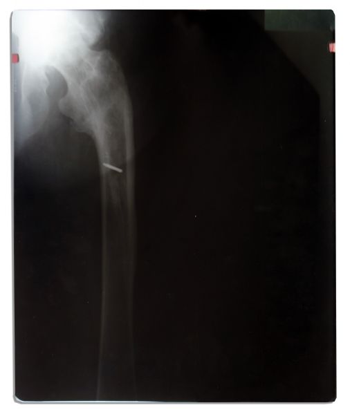 One-of-a-Kind Evel Knievel Arm X-Ray -- Taken After the Daredevil's Disastrous 1975 Wembley Stadium Jump