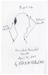 Signed Drawing of President Kennedys Wounds by Dr. Robert McClelland, the Physician Who Held President Kennedys Head at the Dallas Hospital